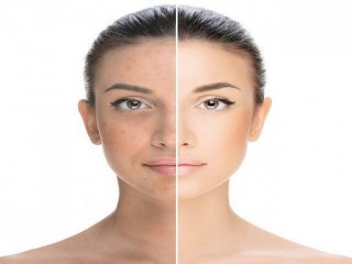 Аппаратная чистка лица. BB Glow treatment., Владивосток
